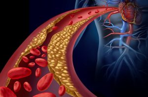 A cartoon of blood vessels partially obstructed with fatty deposits